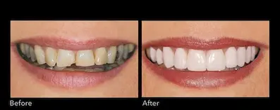 hollywood smile veneers